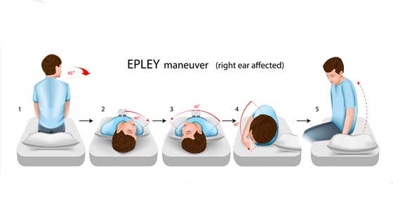 Step-by-step Epley maneuver for vertigo