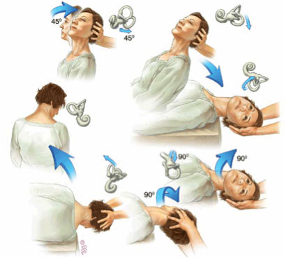 Epley maneuver for BPPV